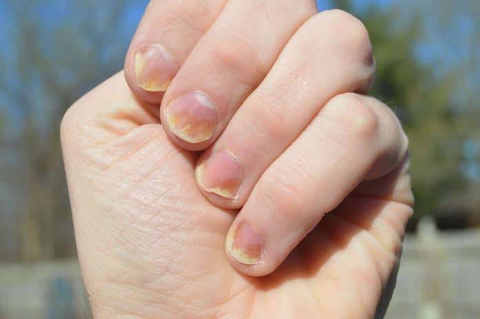 Ongles jaunes : quelles sont les causes et les traitements ? Ongles jaunes : quelles sont les causes et les traitements ?