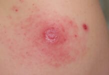 Brûlure après épilation laser du maillot : que faire pour apaiser la peau ? découvrez nos conseils pour apaiser rapidement la peau après une brûlure due à l’épilation laser du maillot et éviter complications et inconfort. solutions, gestes à adopter et erreurs à éviter.