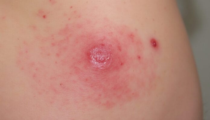 découvrez nos conseils pour apaiser rapidement la peau après une brûlure due à l’épilation laser du maillot et éviter complications et inconfort. solutions, gestes à adopter et erreurs à éviter.